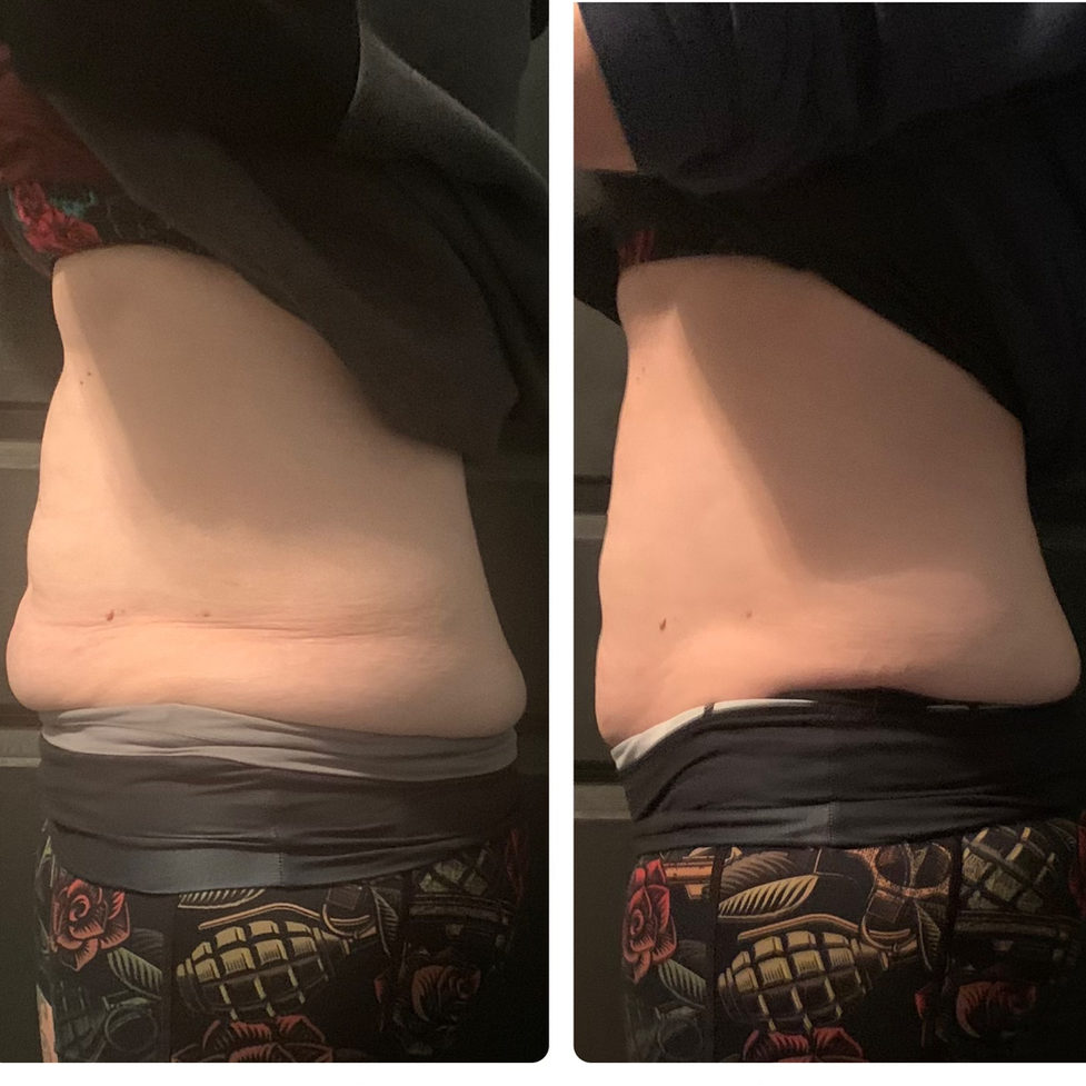 BTL Vanquish results Columbus BTL Vanquish results Columbus